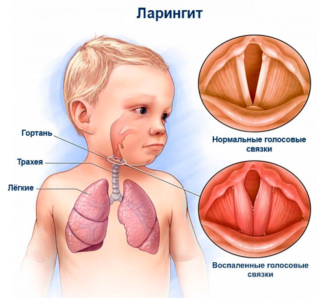 Довольно частой причиной стеноза гортани у детей является острый ларинготрахеит, который развивается у детей дошкольного возраста вследствие анатомических особенностей строения гортани
