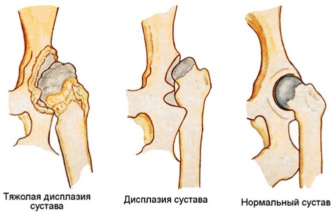 Дисплазия тазобедренного сустава