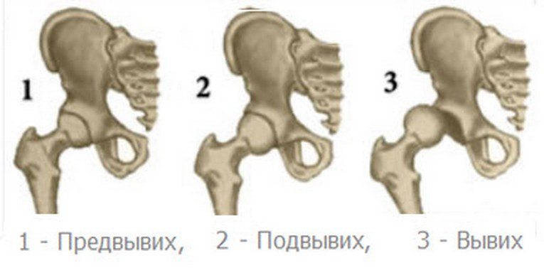 Стадии дисплазии 