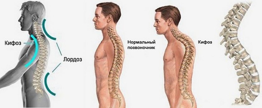 Развитие кифоза и лордоза 