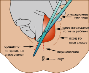 Episiotomy.gif