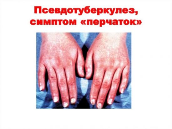 Симптом перчаток