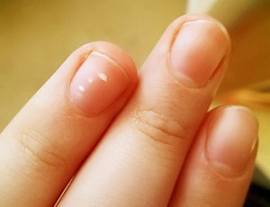 У ребенка появились белые пятна на ногтях
