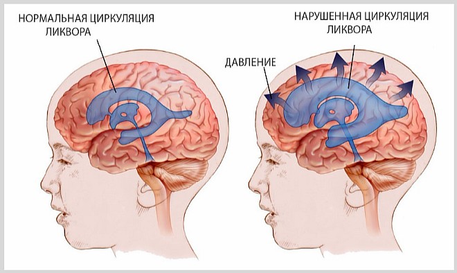Что такое водянка (гидроцефалия) головного мозга у новорожденных