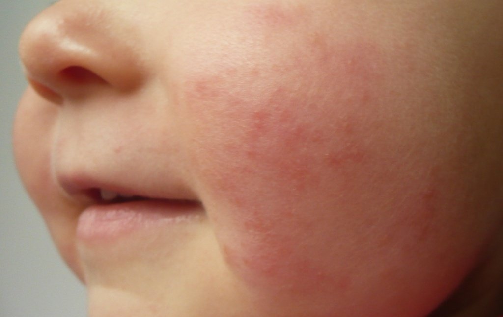 аллергическая сыпь у детей фото