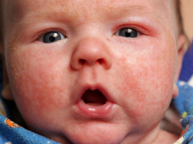 Сыпь на лице у новорожденного 1 месяц Комаровский