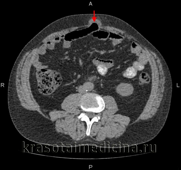 КТ органов брюшной полости.  Небольшая пупочная грыжа, содержащая часть поперечной ободочной кишки