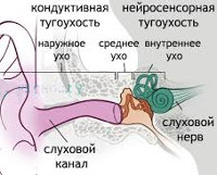 Нейросенсорная тугоухость