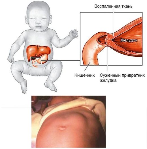 Симптомы пилоростеноза