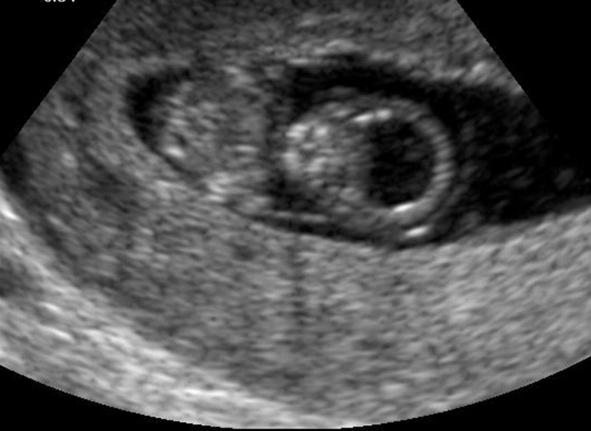 УЗИ 6 недель беременности