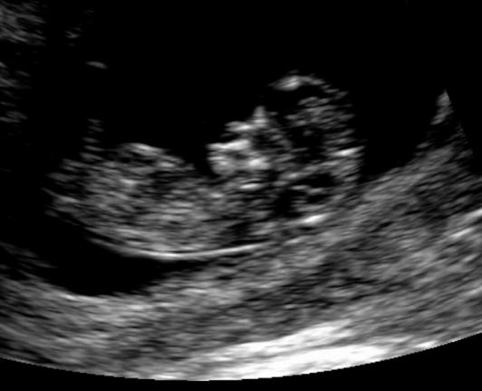 беременность 6 недель узи фото