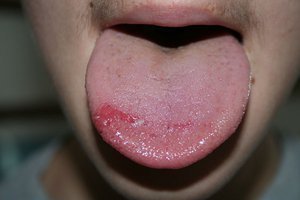 Травма кончика языка у ребенка