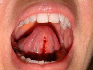 Травмы уздечки языка