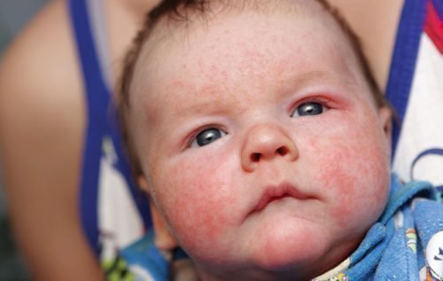 Аллергия у ребенка - причина сухости и запаха изо рта