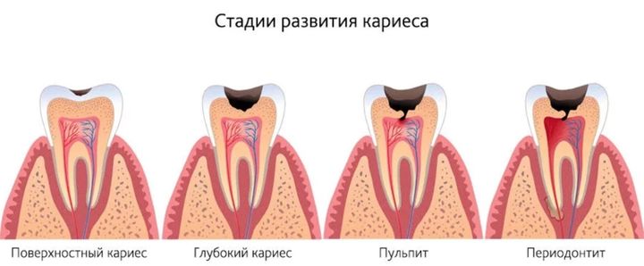 Стадии развития кариеса