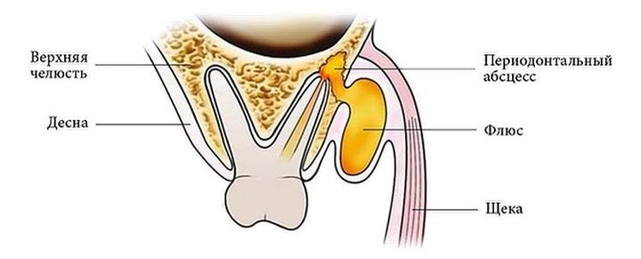 Образование флюса на десне